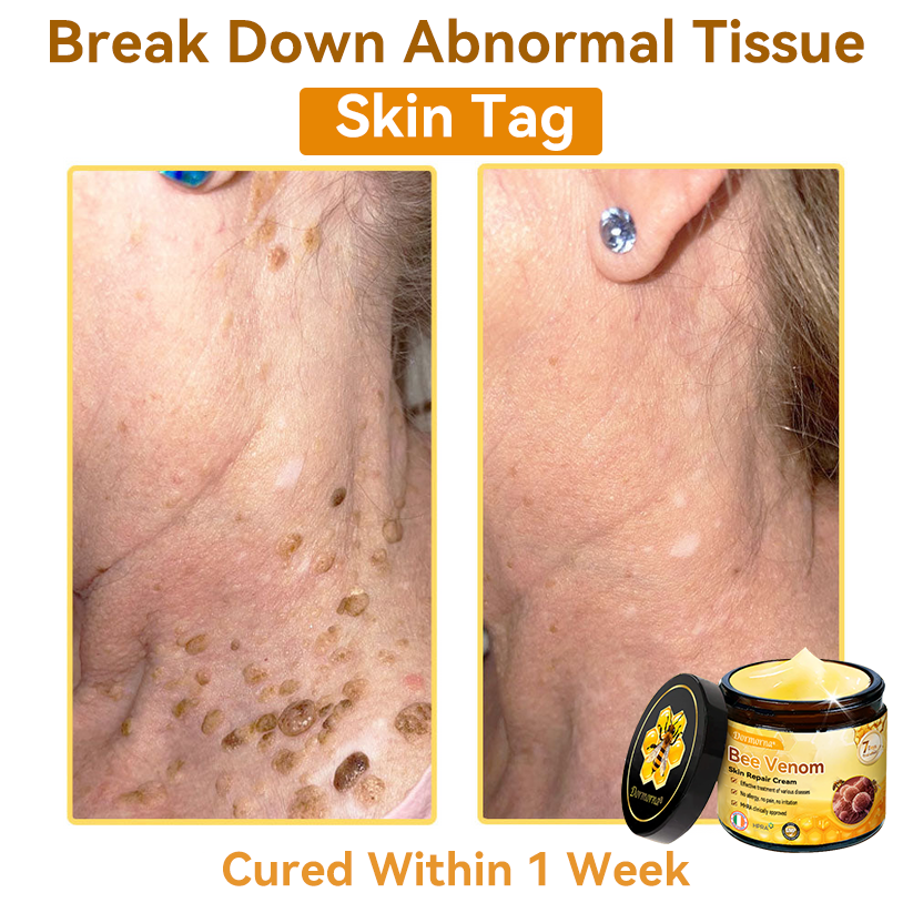 (🚚Made and shipped from Ireland✅) 𝐃𝐨𝐫𝐦𝐨𝐫𝐧𝐚®🍀Bee Venom Skin Repair Cream- LAST DAY 70% OFF