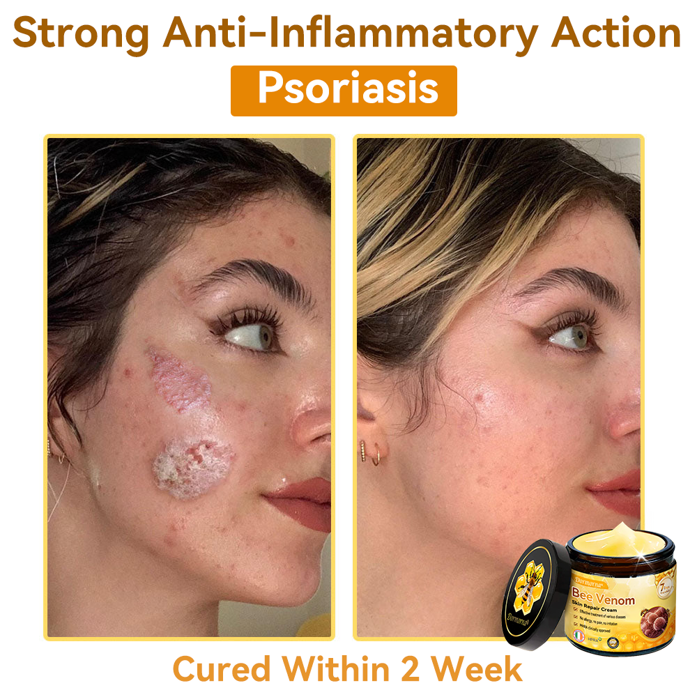(🚚Made and shipped from Ireland✅) 𝐃𝐨𝐫𝐦𝐨𝐫𝐧𝐚®🍀Bee Venom Skin Repair Cream- LAST DAY 70% OFF