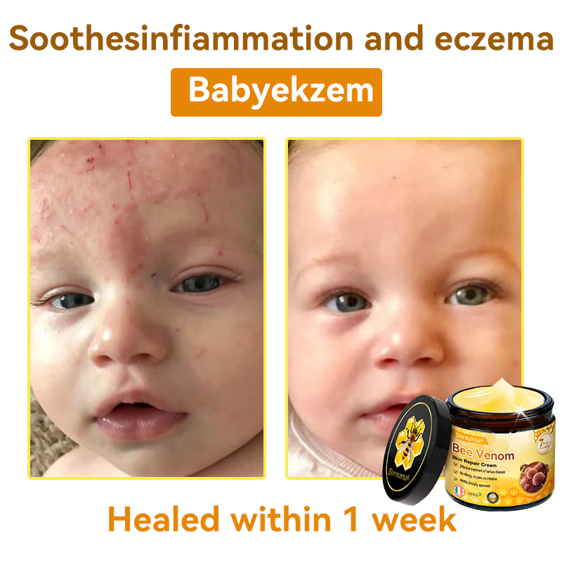 (🚚Made and shipped from Ireland✅) 𝐃𝐨𝐫𝐦𝐨𝐫𝐧𝐚®🍀Bee Venom Skin Repair Cream- LAST DAY 70% OFF
