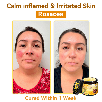 (🚚Made and shipped from Ireland✅) 𝐃𝐨𝐫𝐦𝐨𝐫𝐧𝐚®🍀Bee Venom Skin Repair Cream- LAST DAY 70% OFF