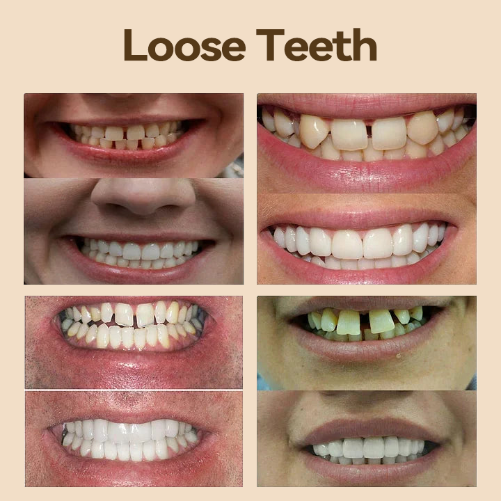 𝐇𝐢𝐝𝐨𝐧𝐞® 🐼🐼- 𝐏𝐫𝐞𝐦𝐢𝐮𝐦 𝐃𝐞𝐧𝐭𝐮𝐫𝐞- (✨Suitable for all mouth shapes, custom-made dentures for a perfect fit✨）