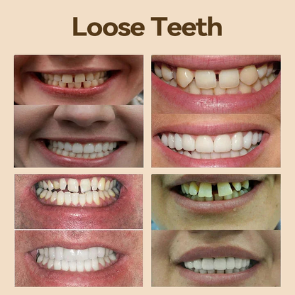 𝐇𝐢𝐝𝐨𝐧𝐞® 🐼🐼- 𝐏𝐫𝐞𝐦𝐢𝐮𝐦 𝐃𝐞𝐧𝐭𝐮𝐫𝐞- (✨Suitable for all mouth shapes, custom-made dentures for a perfect fit✨）