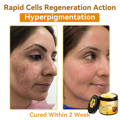 (🚚Made and shipped from Ireland✅) 𝐃𝐨𝐫𝐦𝐨𝐫𝐧𝐚®🍀Bee Venom Skin Repair Cream- LAST DAY 70% OFF
