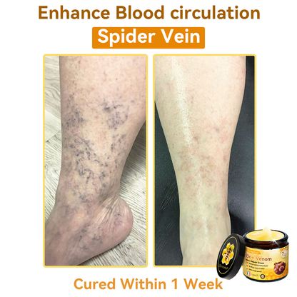 (🚚Made and shipped from Ireland✅) 𝐃𝐨𝐫𝐦𝐨𝐫𝐧𝐚®🍀Bee Venom Skin Repair Cream- LAST DAY 70% OFF