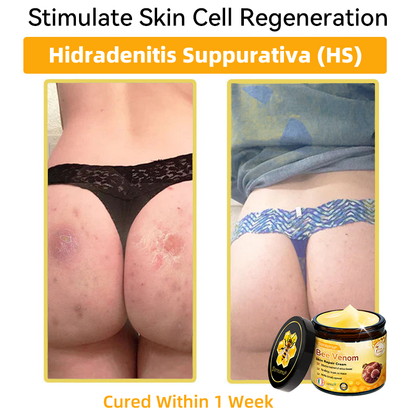 (🚚Made and shipped from Ireland✅) 𝐃𝐨𝐫𝐦𝐨𝐫𝐧𝐚®🍀Bee Venom Skin Repair Cream- LAST DAY 70% OFF