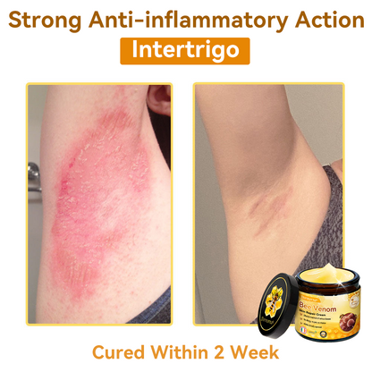 (🚚Made and shipped from Ireland✅) 𝐃𝐨𝐫𝐦𝐨𝐫𝐧𝐚®🍀Bee Venom Skin Repair Cream- LAST DAY 70% OFF