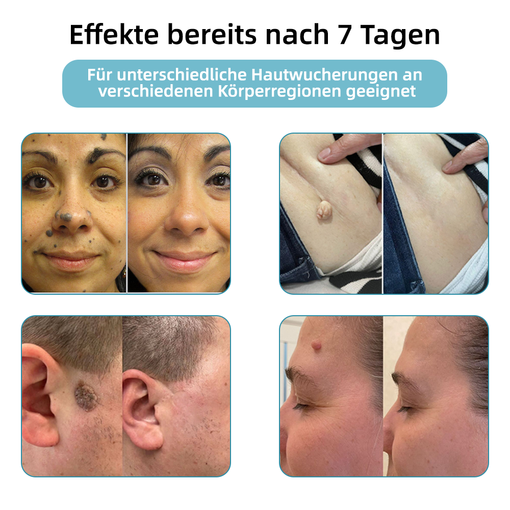 𝐉𝐚𝐬𝐬𝐞𝐞𝐦® medizinischä Laserpen 🚚🎁 (nutzt CO₂-Lasertechnologii – wirkungsvoll zum Entfernä vo Muttermalä, Warzä, Hautanhängslä, Pigmentfleckä und andere Hautunreinheite)
