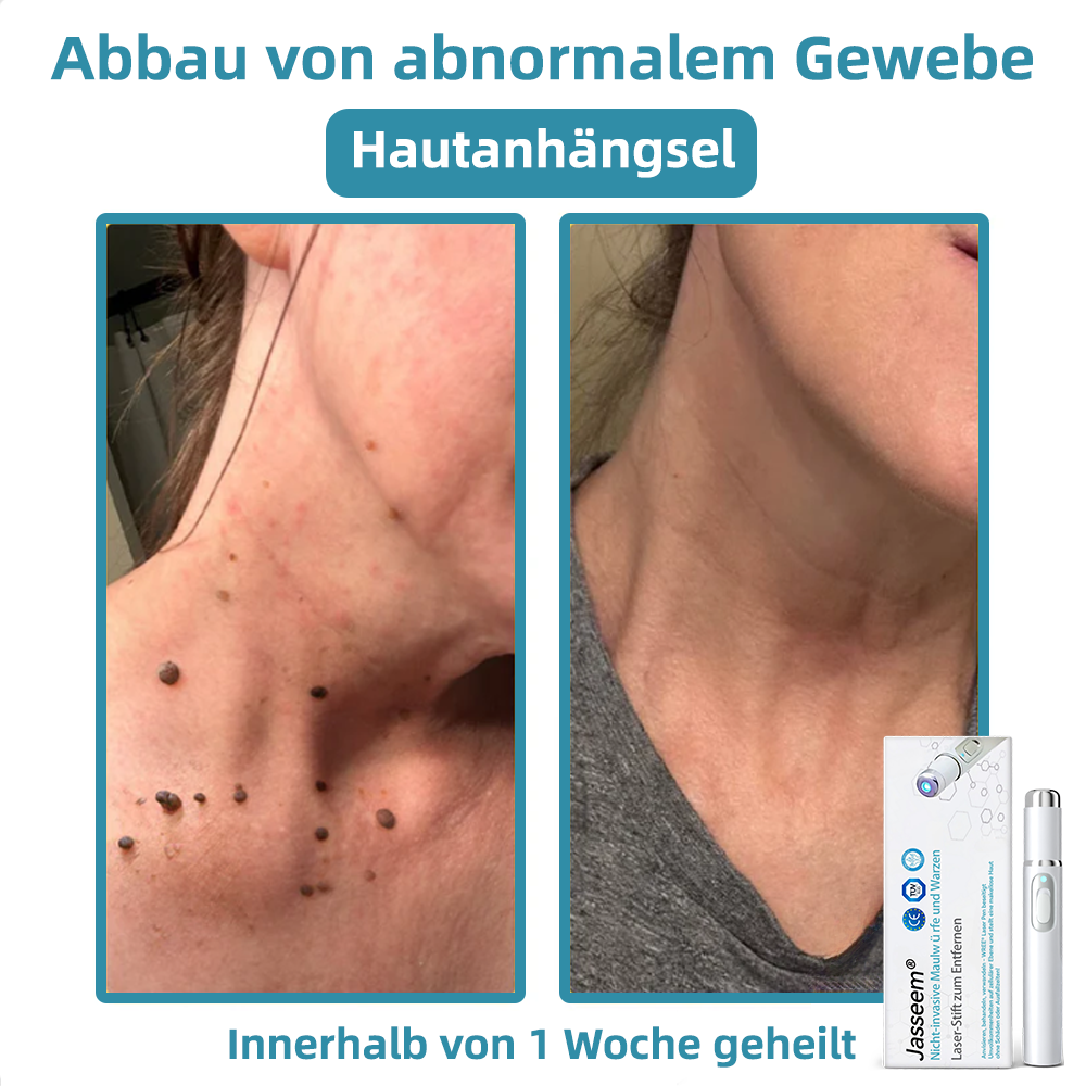 𝐉𝐚𝐬𝐬𝐞𝐞𝐦® medizinischä Laserpen 🚚🎁 (nutzt CO₂-Lasertechnologii – wirkungsvoll zum Entfernä vo Muttermalä, Warzä, Hautanhängslä, Pigmentfleckä und andere Hautunreinheite)